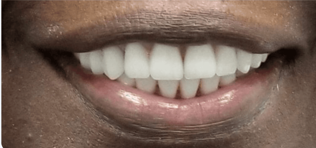 After smile treatment