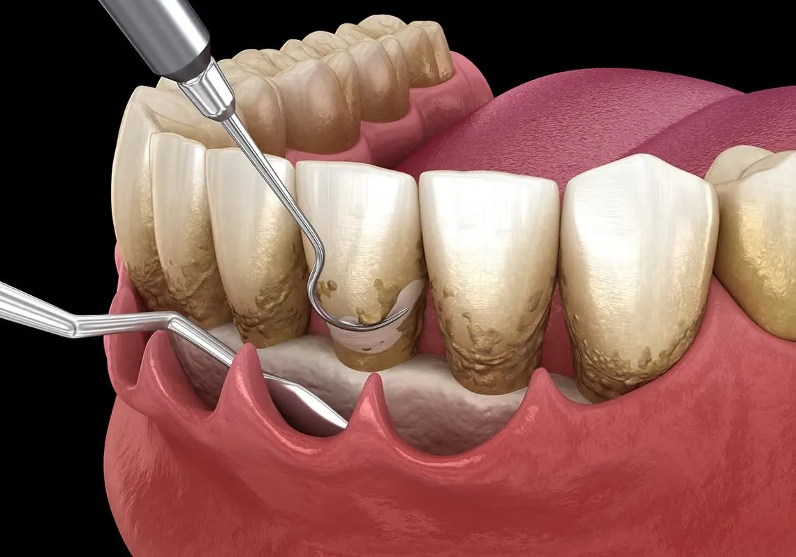 የድድና የአጥንት ሕክምና Treatment at Green Life Dental