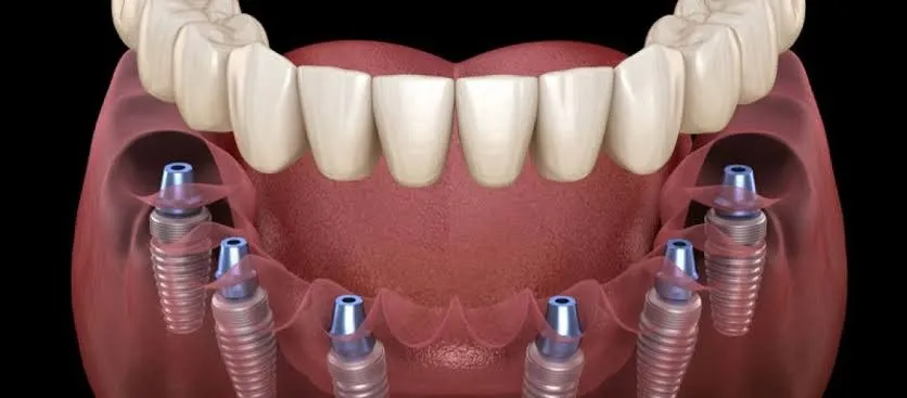 ሙሉ የመንጋጋ ጥርስ ተከላ Treatment at Green Life Dental