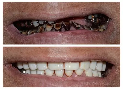 ሙሉ የአፍ ጥርስ መልሶ ግንባታ Treatment at Green Life Dental