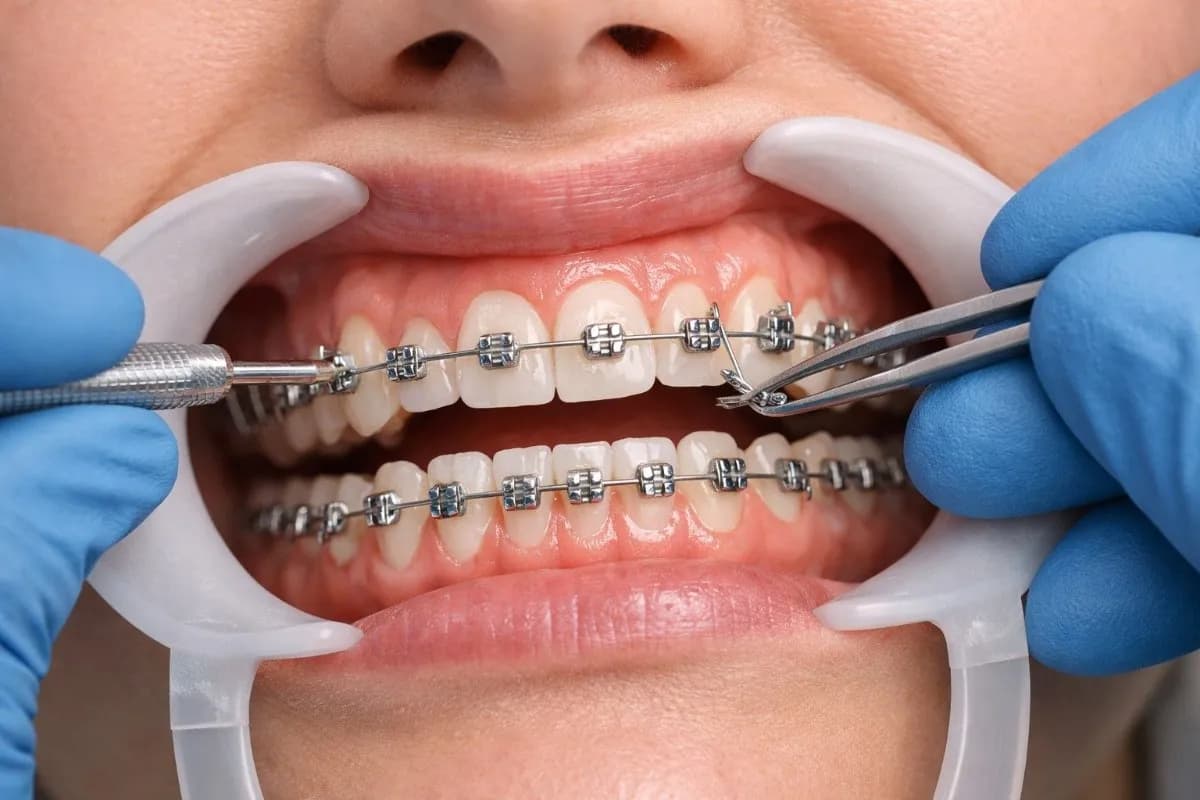 ብሬስ Treatment at Green Life Dental